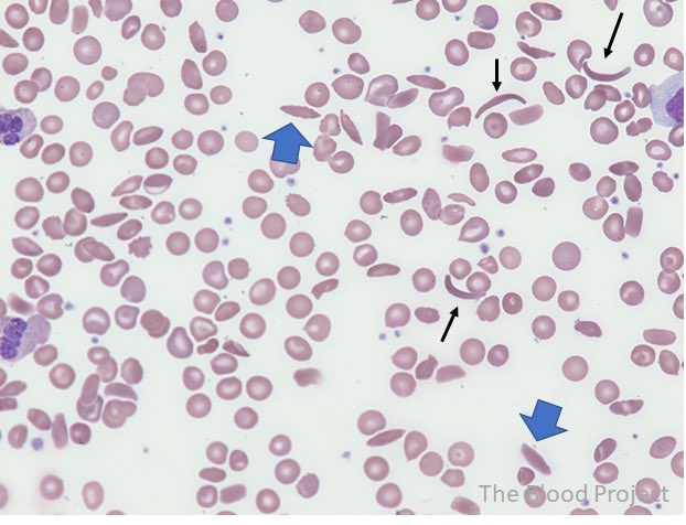 What is your spot diagnosis?

A- sickle cell anemia
B- spherocytosis
C- ellyptocytosis
D- thalassemia 

#Usmle #DrSam👩🏼‍⚕️🩺 #medtwitter #match2024 #match2023 #ecfmg #ecfmgcertificate