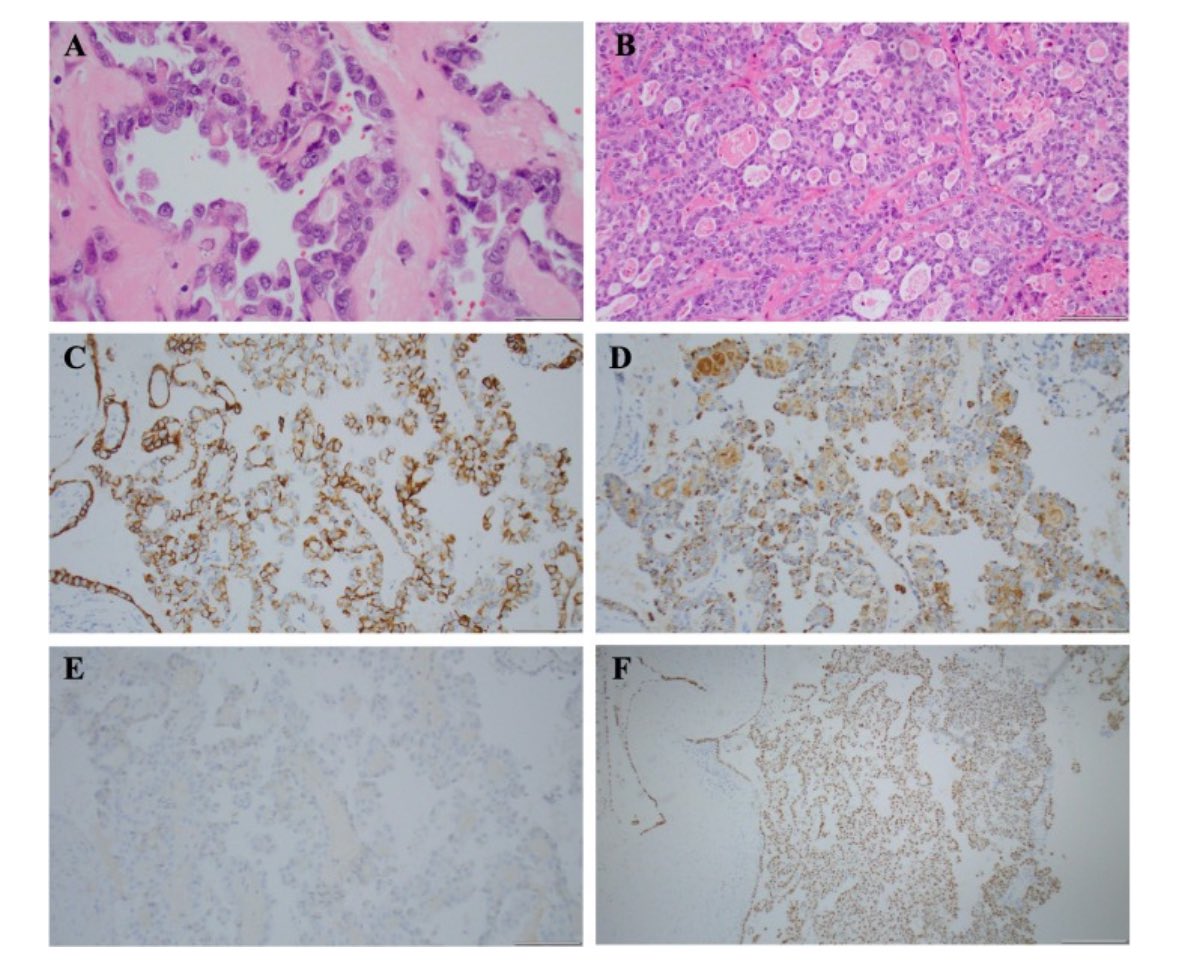 Primary peritoneal clear cell carcinoma arising in the setting of abdominal wall endometriosis @ISGynP @SGO_org @IGCSociety @ESGO_society @ASCO @OncoAlert sciencedirect.com/science/articl…