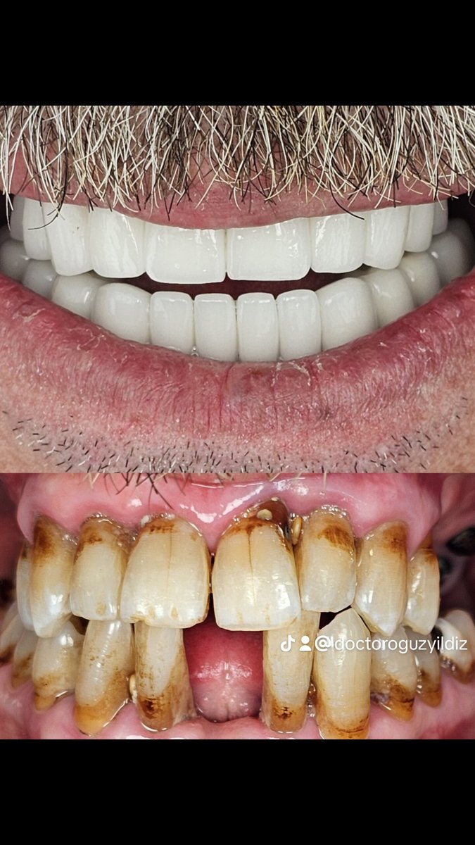 Tüm çene rehabilitasyonu. Zirkonyum porselenler İle gülüş tasarımı. #porcelainveneers #smiledesign #teethwhitening #estheticdentist #dentalclinicnearistanbul