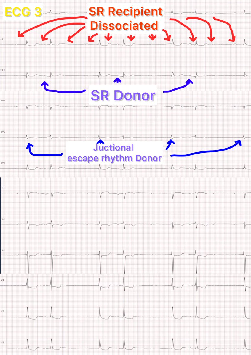 👇 Fascinating #HTX_ECGs for students and fellows👇 #EPeeps 3 scenarios and 3 ECGs 🤩🤩 #HTX_ECG_1: Atrial tachycardia in the donor atrium and dissociated sinus rhythm in the recipient atrium. #HTX_ECG_2: The opposite of ECG 1. Sinus rhythm in the donor atrium and dissociated…