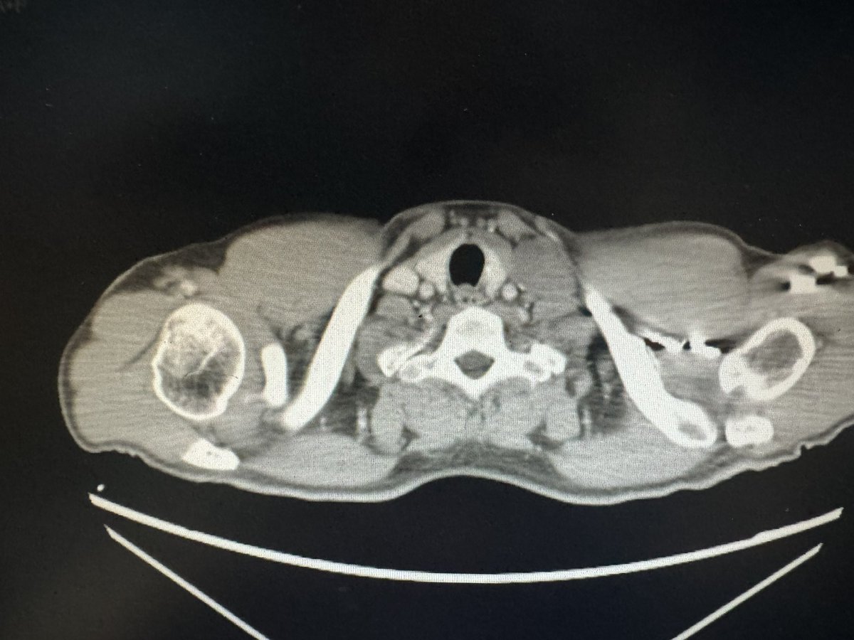 TCa D7 When the disease is beyond the retro-peritoneum!! Post-chemo disease in the RP + lungs/liver/supraclav LNs Do you always resect extra-RP disease? Does it depend on the RP pathology? Do you do it simultaneously or staged? Some answers from our data @TataMemorial