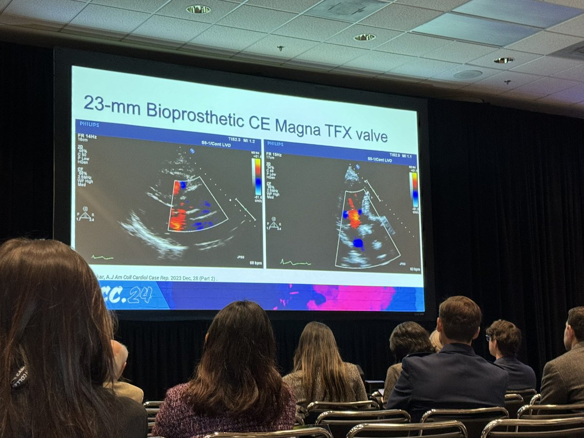 Dr. @EstefaniaOS on diagnosing #CardioObstetrics cases using #echofirst and ECGs #ACC24 #cvEcho #ECG #CardioOB #CardioOnc #JACCCaseReports #cvImaging #JACCIMG