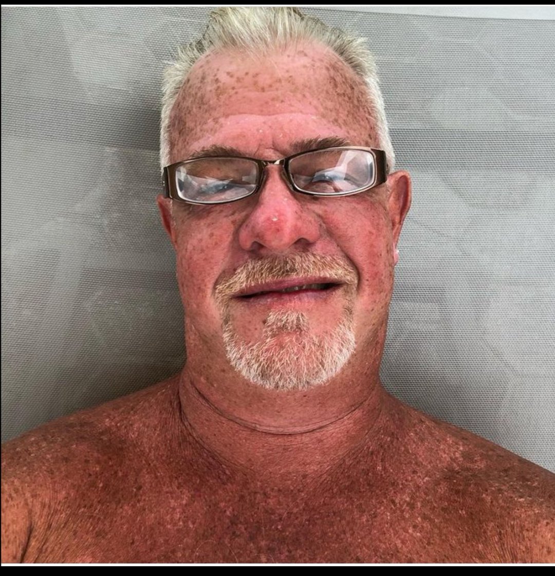 Jack Rust. Honestly wtf is this. His chest looks like roasted beef. Jack Krust. Just blue light toxicity lmao. You can see Asians that hide from the sun with perfect smooth no spot skin. U want some vitamin D though, but compare the extremes. White skin always been aristocratic