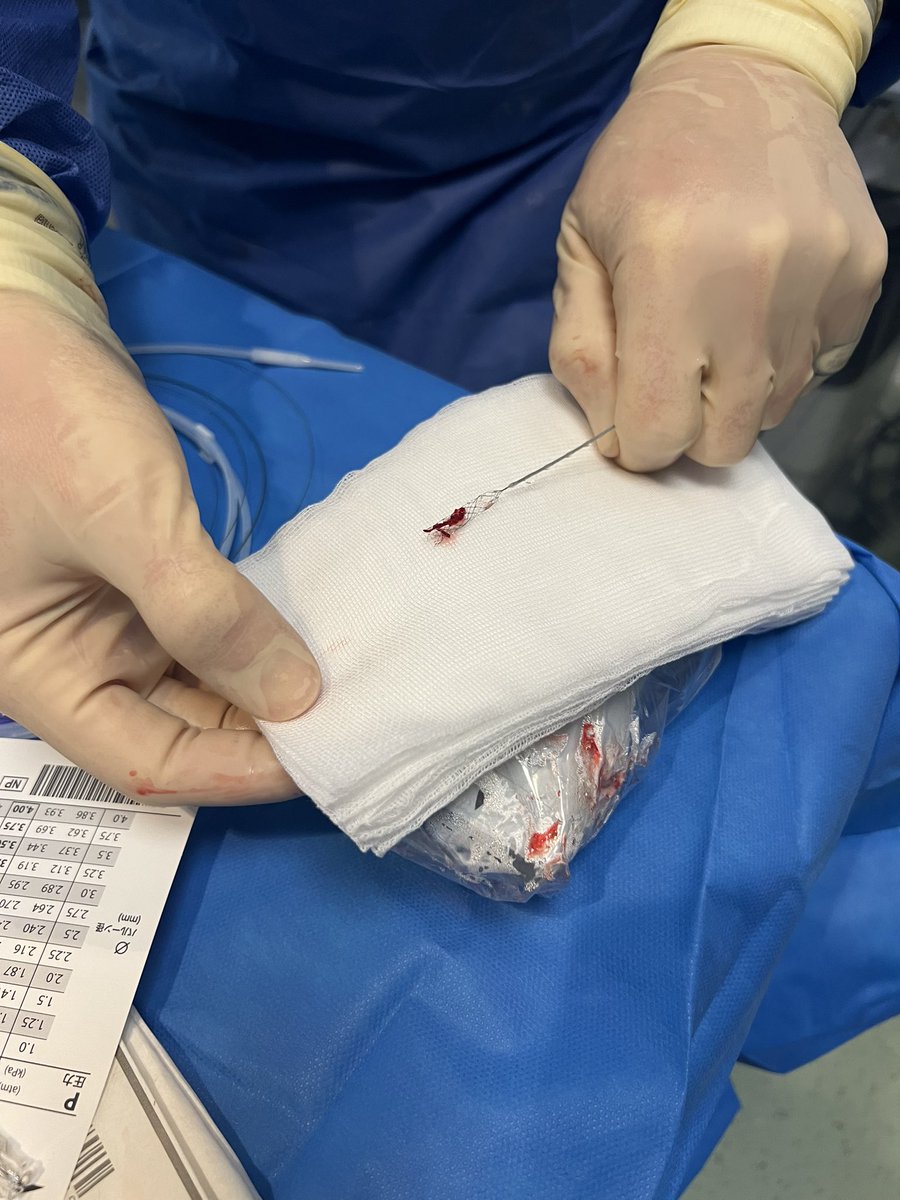 First use of the #AperioHybrid stentretriever from <a href="/Acandisgmbh/">Acandis</a> in Erasme, Brussels 

4x30 in a #Trevotrak21 from <a href="/Stryker_NV/">StrykerNeurovascular</a>, a #Walrus <a href="/q_apel/">Q'Apel Medical</a> for a M1-M2 occlusion, mTICI 2c in 2 pass

<a href="/neurovascu_lab/">NeuroVascu lab Brussels</a> <a href="/RadioLogs/">RadioLogs</a>