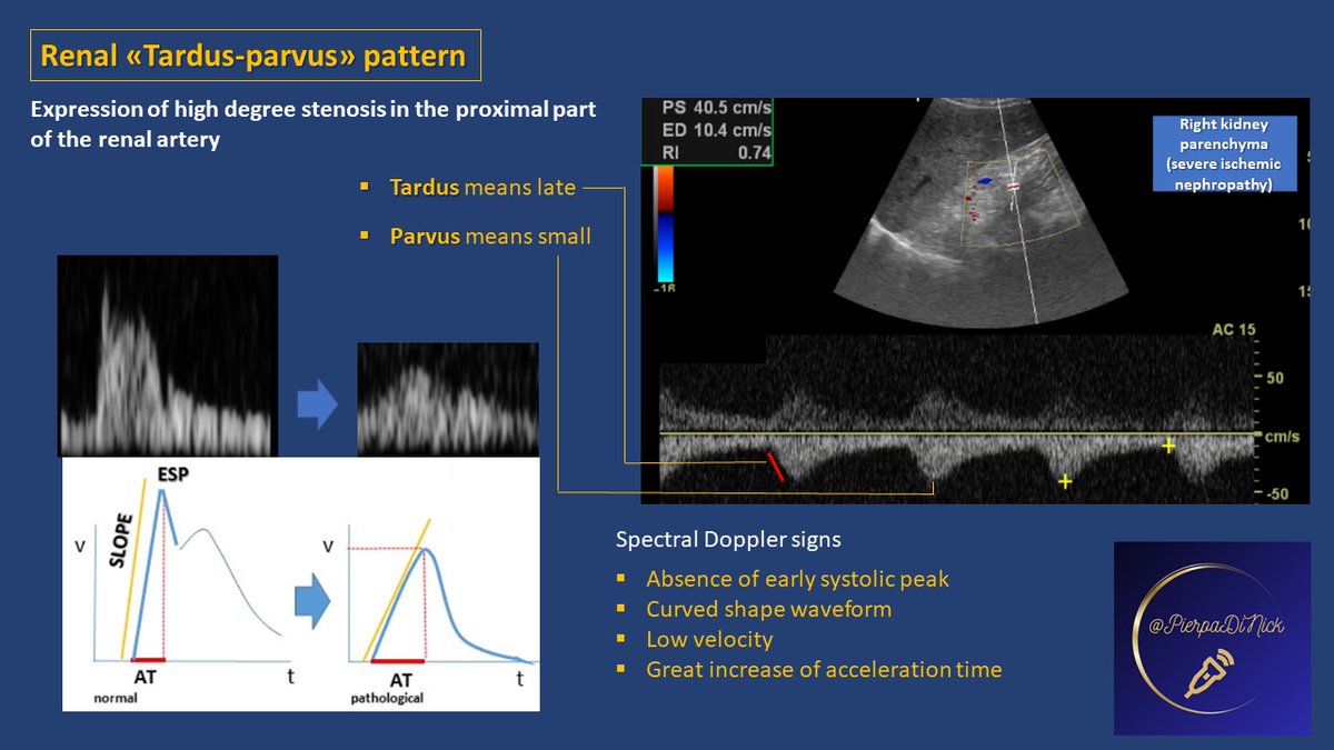 #Pocus #RenalDoppler #MedEd What are we talking about when we say Tardus Parvus pattern... 👉a small explaining panel for students and trainees