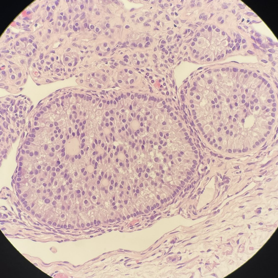A+++ to the person who can dunk this diagnosis with a few clues 🔎 bilateral ovarian lesions 🔎 associated with Peutz-Jeghers syndrome 🔎 has STK11 mutation #GYNPath #PathTwitter #PathX