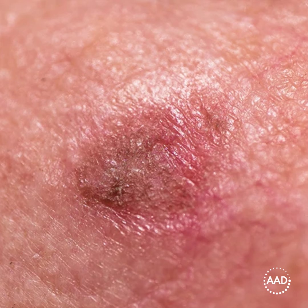 The AAD is looking to help build better dermatology measures for clinical practice, DataDerm™, and MIPS. If you see patients with actinic keratoses, then the AAD encourages you to participate in the AK measure testing program. aad.org/member/clinica…