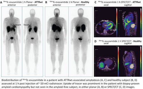 DETECTION OF AMYLOID CARDIOMYOPATHY IN PATIENTS WITH SYSTEMIC ATTR AND AL AMYLOIDOSIS USING SPECT/CT AND PLANAR IMAGING OF A TECHNETIUM-99M-LABELED PEPTIDE - TECHNETIUM-99M (99MTC) EVUZAMITIDE | JACC jacc.org/doi/10.1016/S0… New tracer!!! @MyASNC @estelais @DorbalaSharmila