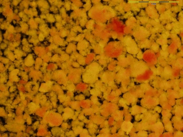 It always amazes me what we can get from an organ donor pancreas with type 1 diabetes. Tremendously valuable for understanding the disease. Massive respect to families that support research. (Reddish staining indicates cells with insulin).