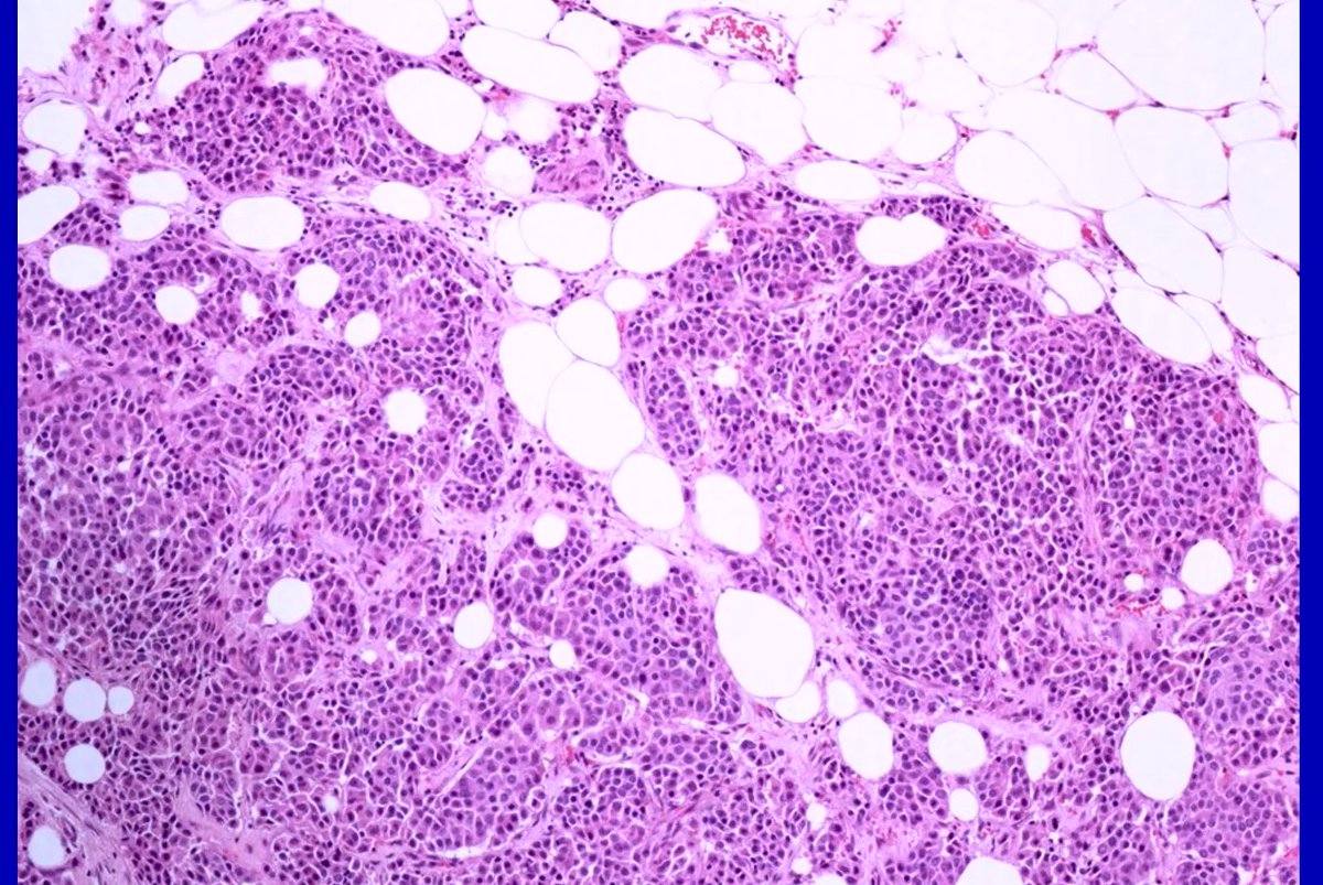 #EverydayBreast Is this a primary breast neuroendocrine carcinoma or something else...? 🧵A tread with IHC and final diagnosis 👇 Dr. Rakha #USCAP2024 #PathX #PathTwitter #pathologist #pathresidents #NIPPathX #Breastpath
