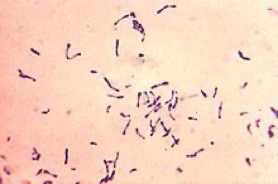 A young unvaccinated child presents with fever, sore throat, barking cough & hoarseness for 5 days. Gram stain w/gram + pleomorphic bacillus. What is the likely diagnosis? (Image: Wikipedia) #MedX