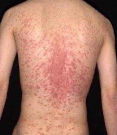 A 20-year-old boy came w/a scaly, non itchy rash on his trunk. He recalls having a mild fever & headaches a few weeks prior. He loves to spend a lot of time outdoors. On exam, the lesions are primarily on his central trunk. No lesions on his arms. What is the diagnosis? #medEd
