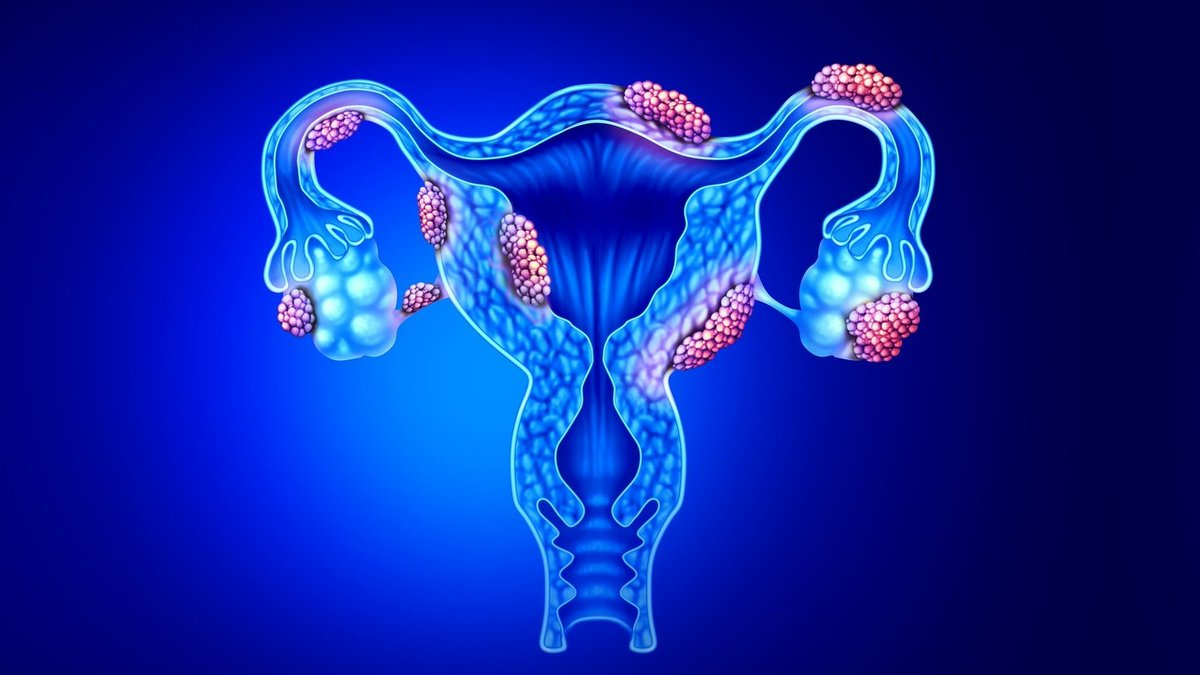 An Israeli femtech startup says it has developed a cure for endometriosis using cannabinoids nocamels.com/2024/04/femtec…