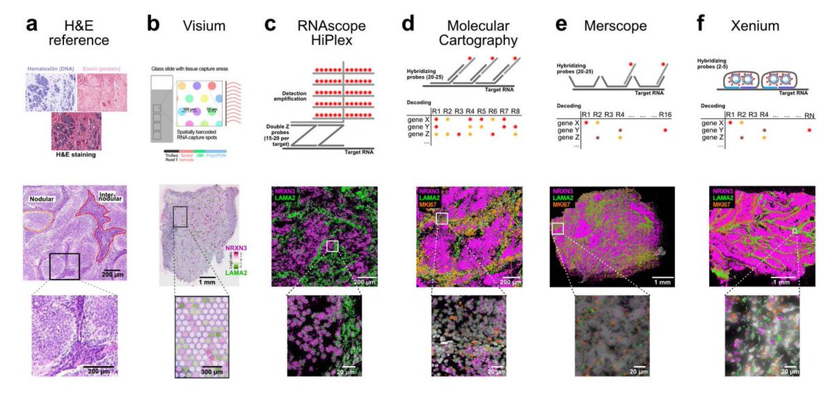 Comparison of spatial transcriptomics technologies used for tumor cryosections 🧐biorxiv.org/content/10.110…