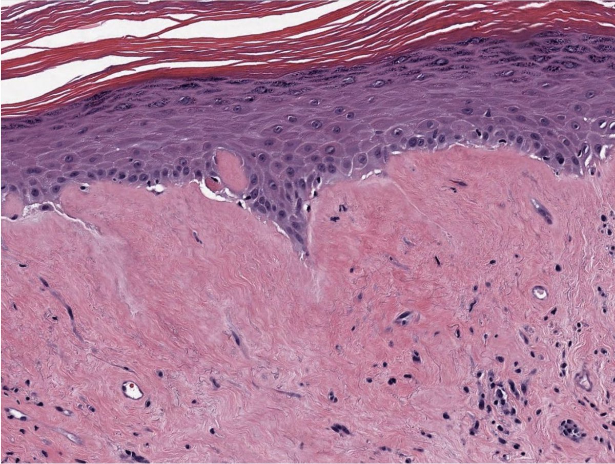 60 y/o F w  atrophic hypopigmentation of labia minora

This increases her risk for differentiated vulvar intraepithelial neoplasia VIN (not HPV driven)  

What is the diagnosis?🤔  

Credit: Kelly Hall, MD  #pathagonia #path4people #dermpath #fammed #pathx #pathtwitter #gynpath