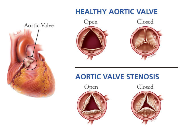 Aortic stenosis can present with SAD.
S= syncope
A=angina
D=dyspnea.

#MedTwitter #MedEd #medicine #Cardiology #CardioEd #FMGE #NEETPG #INICET #USMLE #PLAB