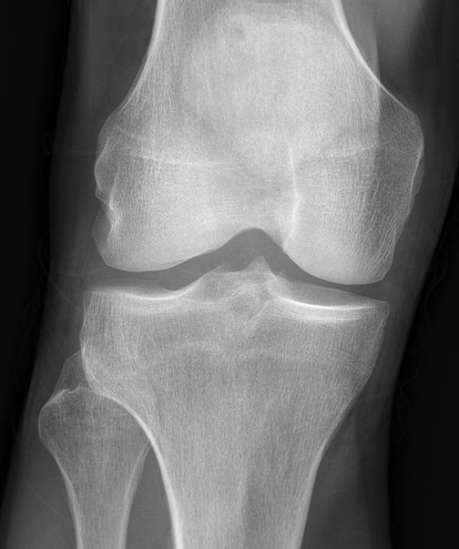 #CaseOfTheWeek...End🎉

📢✅Answer for Case #13: dislocated proximal tib-fib joint❕❗ 🦵🦵🦵

Right knee radiographs for comparison

Have a great week!!🥳🎉

#FOAMrad #RadEd #MedEd #OrthoEd #OrthoTwitter @ssr_rwg @UWRadRes @otatrauma