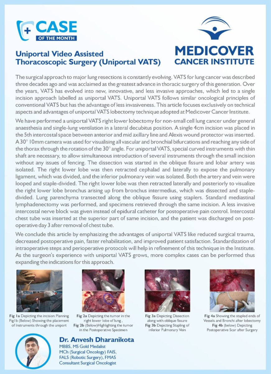 Uniportal VATS has been adopted by us as the access of choice for major lung resections. This article describes the technical aspects and advantages of Uniportal VATS Right Lower Lobectomy performed for NSCLC at Medicover Cancer Institute, Hyderabad.
📞094402 33339
