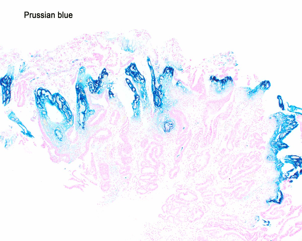 Iron medication-associated carditis has resulted in striking reactive epithelial changes. The PAS stain shows a slender strip of neutral mucin in the epithelial cells in question. #UMiamiPath