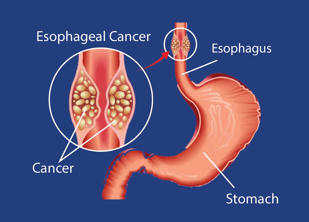 Be vigilant for potential signs of #esophagealcancer such as difficulty swallowing, hoarseness, persistent cough, weight loss, or increased indigestion/heartburn. Talk to your doctor about screening if you notice any of these symptoms. Early detection is key!