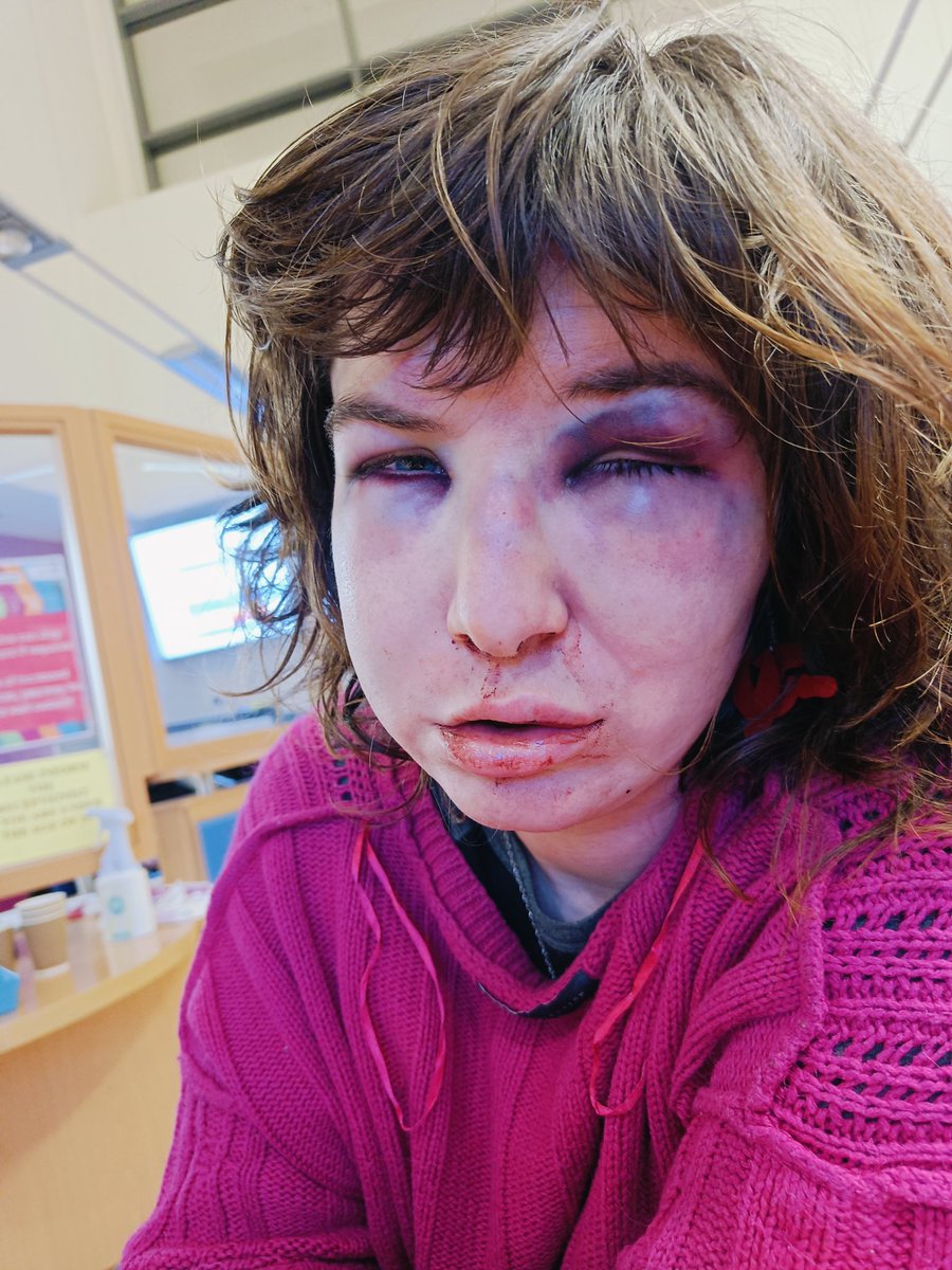 Last night I was beaten up in Coventry in a transphobic hate crime by a group of men. My phone was stolen. My glasses were broken and I can barely see. This is our daily reality If you want to show your support directly, here's my GoFundMe: gofundme.com/f/help-fund-da…