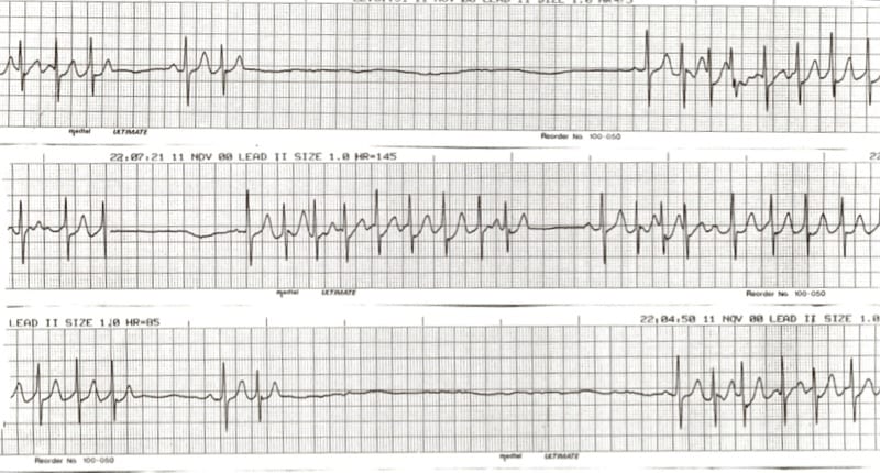 From sick sinus to AVNRT, our new ECG Exigency case presents 5 risky rhythms. Are you up for the challenge? See if you can save the day before it's too late. litfl.com/risky-rhythyms… #FOAMed #MedEd #MedTwitter #CardioTwitter