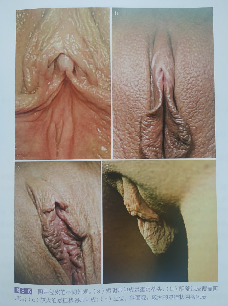 女性小阴唇各异，几乎没有完全对称的。如果站立时小阴唇比大阴唇长2厘米以下是一度肥大，长2-4厘米是二度肥大，长4厘米以上是三度肥大。肥大会影响走路骑车做爱，会摩擦拉扯疼痛变黑。可以考虑小阴唇整形术。
私信依然可以免费帮忙看外观。