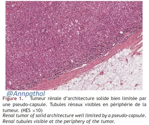 Annpathol's tweet photo. Femme de 35 ans présentant une masse rénale de 5 cm. Diagnostic ?
35-year-old woman with a 5 cm renal mass. Diagnosis ?
#RenalPath #GUPath #francophonepath https://t.co/u9WygLRyBp