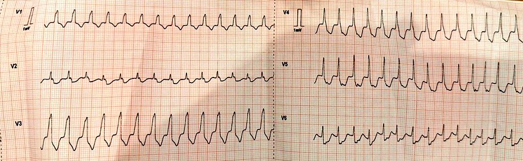 Old man with palpitations. #Epeeps what do you think🫀

@ecgandrhythmRoe @ecgrhythms @narrowQRS @The_Nanashi_O @EF_Cardiaca 

#cardiovascular #CardioTwitter #Cardiology #cardiologist #EKG #ECG #MedTwitter #paramedics #EPS #Medicalstudent #NCT