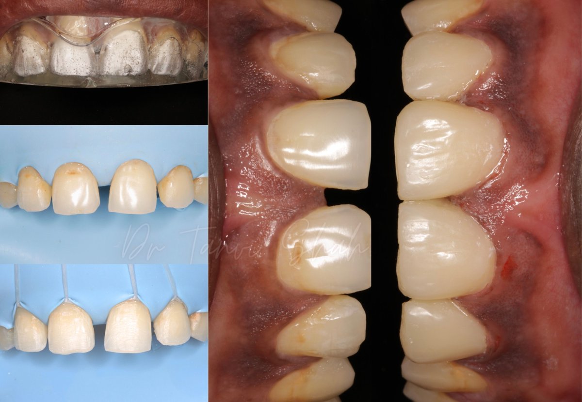 Saveetha Dental College, SIMATS

Predictable esthetic dentistry! Case of injection moulding done by Dr. Tanvishah  (Esthetics, Injection Molding, Smile Makeover).