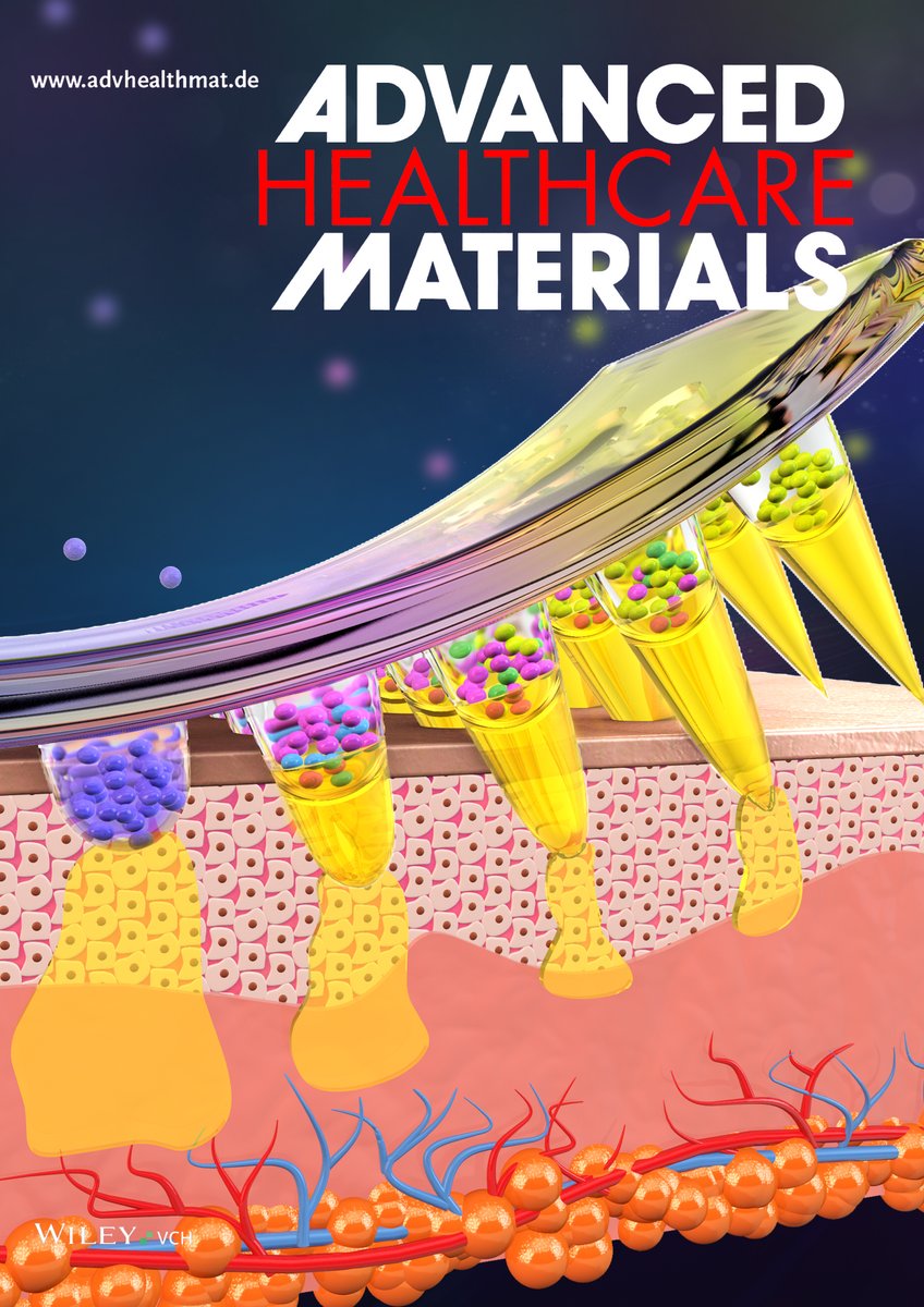 Paper Bonanza part 3: onlinelibrary.wiley.com/doi/10.1002/ad… Here, we show how colour-changing indicators can tell patients when the dose has been delivered from microneedles - Could be an important step forward for the field! @huanh_li @pharmacyatQUB @CRS_FG_SkinMuco #lovequb