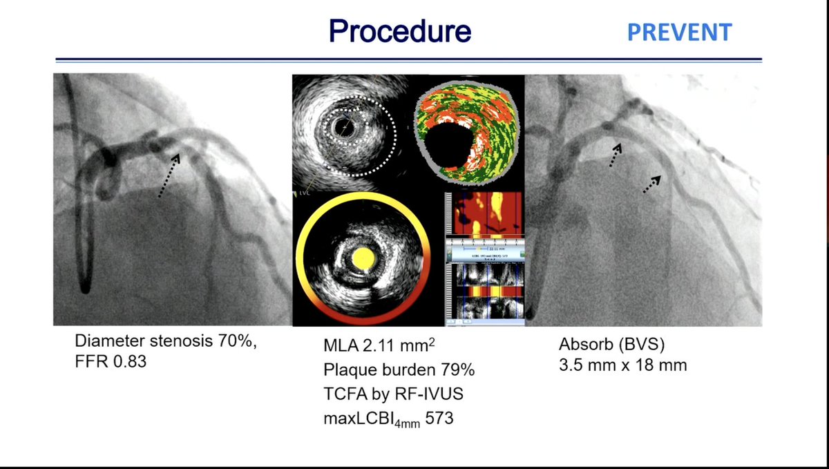 #ACC24 PREVENT discusses non flow-limiting high-risk plaque evaluating, though note stenosis highlighted in presentation! What does this say about utilization/relevance of FFR/iFR on outcomes? So many questions following this trial