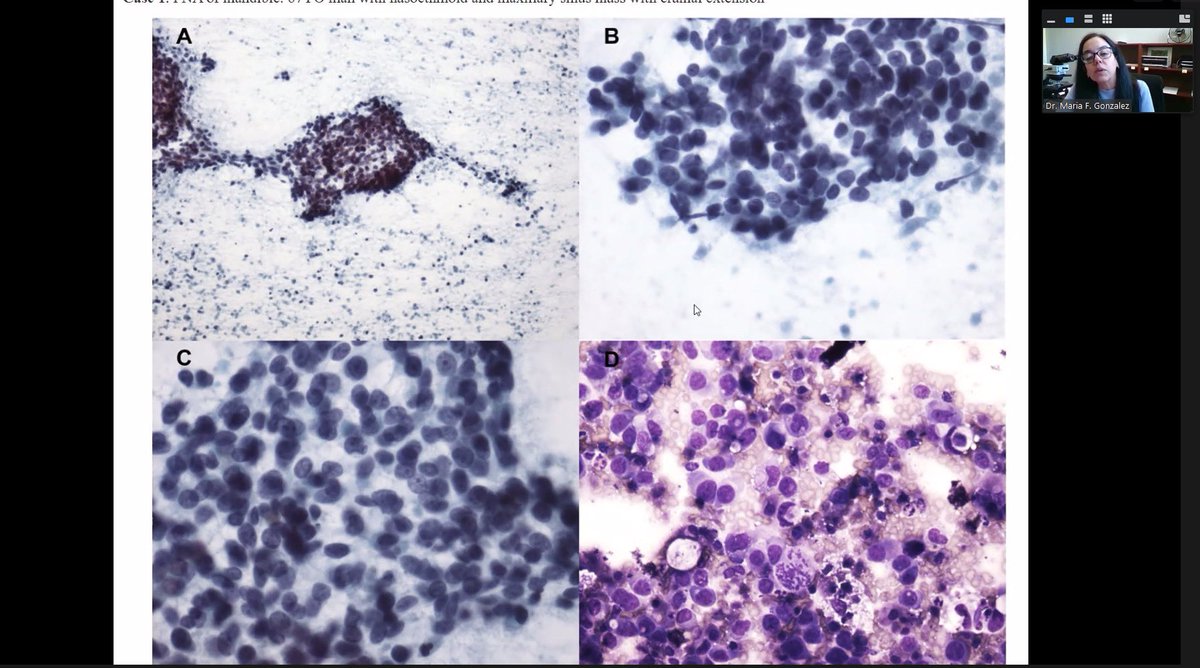 Happening now ! Head and neck board review session by Dr. Maria Gonzalez! #PathTwitter