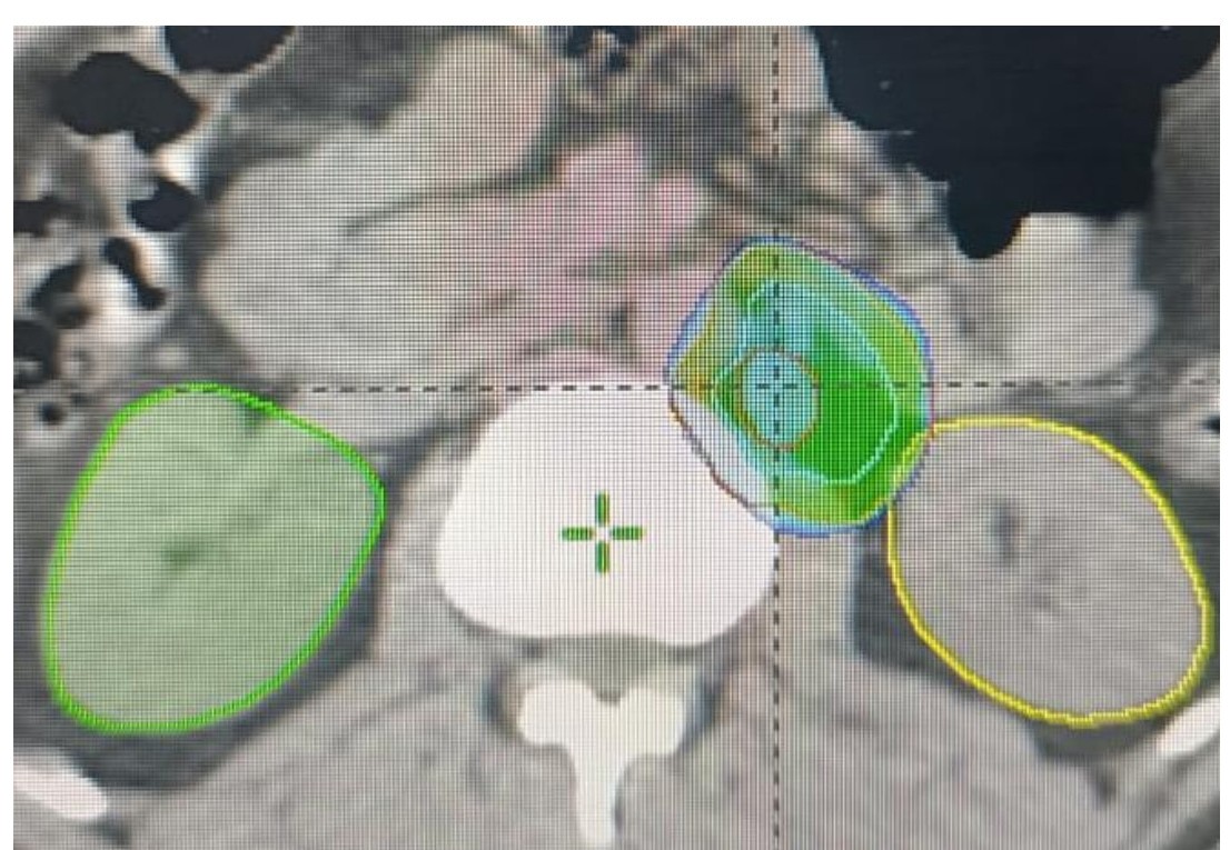 TCa D8 Seminoma with a small RP node. Stage 2a-b Classical Rx has been overkill. Dog leg RT 😕 3x BEP 😭😭 The folks at SAKK have made it so elegant. @Alex_Papachris @Silke_Gillessen @CDFankhauser 1x Carboplatin and IFRT 😊 Very cool and very effective.