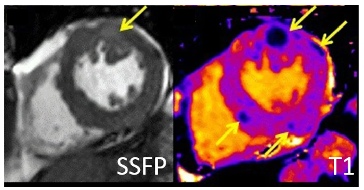 Are you ready for April Adventure: Battle of the Imagers - Jeopardy Edition? What CV pathology may present with a low T1 value? Attend the session to see if you got the answer right! @WPBandettini @AmrIdris @NitiCardio #ACC24