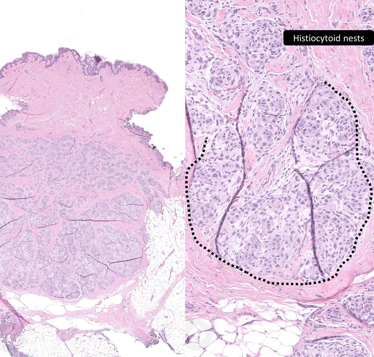 11yo boy, nodule on back, diagnosis? A) Atypical spitz nevus B) Epithelioid fibrous histiocytoma C) Cellular neurothekeoma D) Plexiform fibrohistiocytic tumor #bstpath #dermpath #pathtwitter #pathresidents