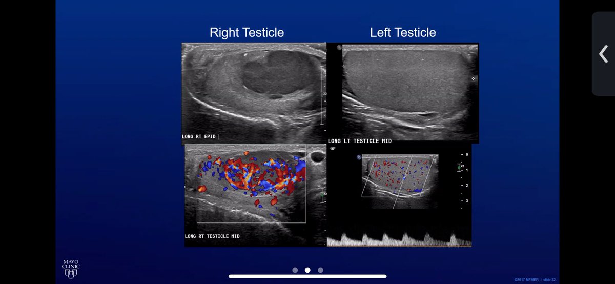 MayoUrology's tweet photo. Welcome @UroOnc Fellowship applicants! Here’s a question from #MondayMorningConference to get things started: 29 yoM p/w firm R testis, CT shows large retroperitoneal masses, lung lesions. AFP 297, bHCG 59553, LDH 400. Path shows seminoma, hilar invasion, no LVI. Question in 🧵: https://t.co/sbVuuGbPfn