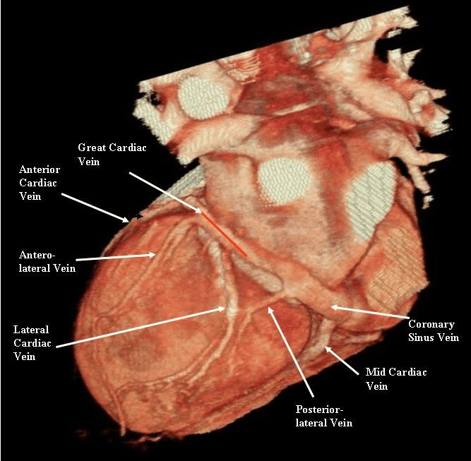 @22tabbah_randa Do you know Coronary sinus is a 'Shy' structure hidden behind the heart,between atria&ventricles in AV groove,looks like a big vein,not very blue, she shows up when unroofed or,rarely rupture when cannulatd,obviously patient death happens unless miraculously repaired surgically.
