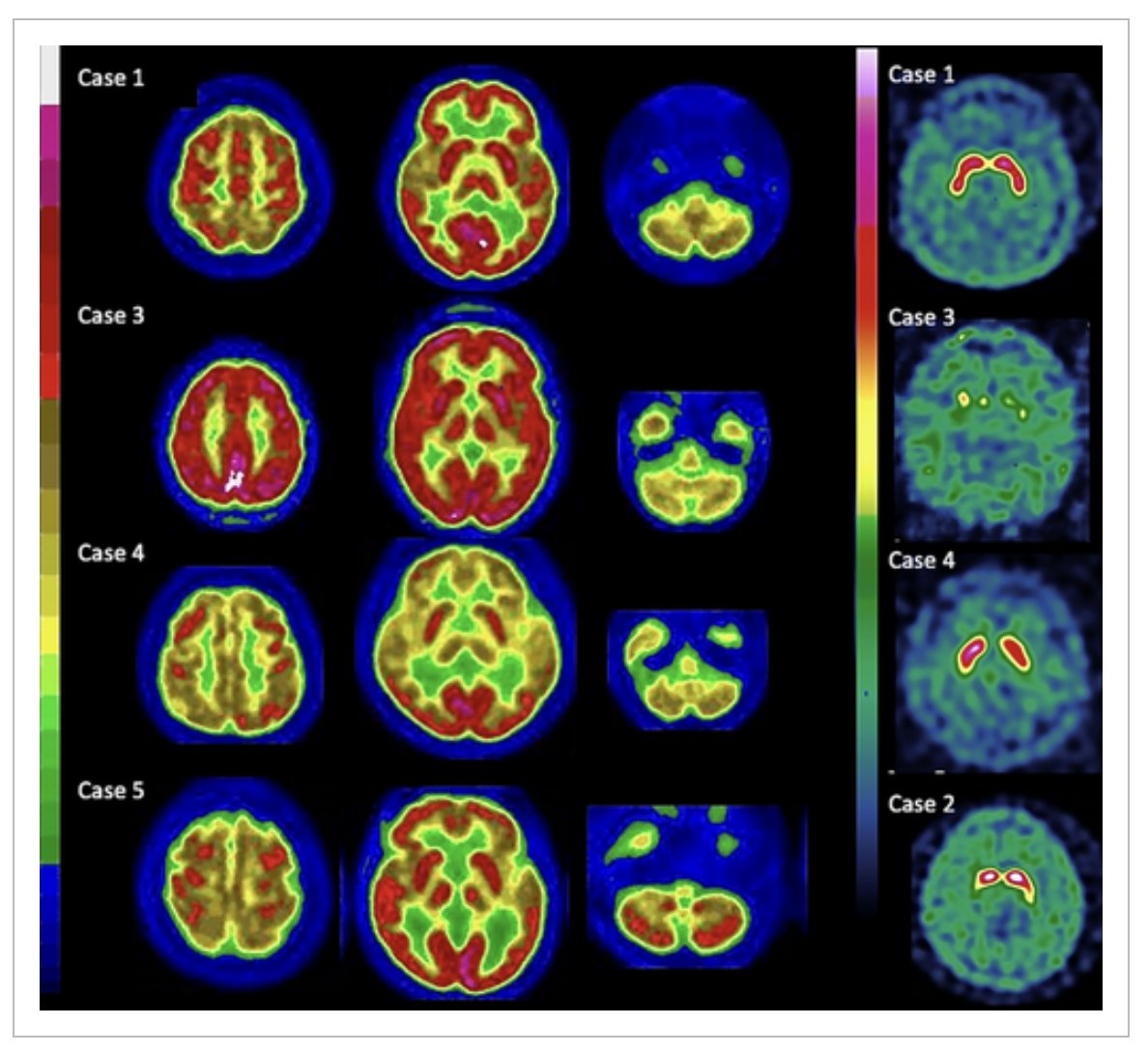 MichaelOkun's tweet photo. CANVAS is turning out to be a very common ataxia syndrome. Be careful with 'why' you order imaging tests as the findings will not be 'universal' in cases with such a large spectrum of clinical presentations. Nice humbling series by Horowitz in @MDJ_Journal.
My take: CANVAS is an acronym: Cerebellar Ataxia (CA), Neuropathy (N) and Vestibular Areflexia (VA) Syndrome (S). The 'why' is the most important reason why we should or should not order an imaging scan or diagnostic test. The genetic testing for CANVAS is hard to access and this will be the most important test when it is widely available. I do think there is great value from a research standpoint to correlating clinical and imaging findings. When you order an imaging scan remember, a fortiori – do it with stronger reason than 'I can.' https://t.co/OQq71VLjpH #ataxia #canvas #Parkinsons