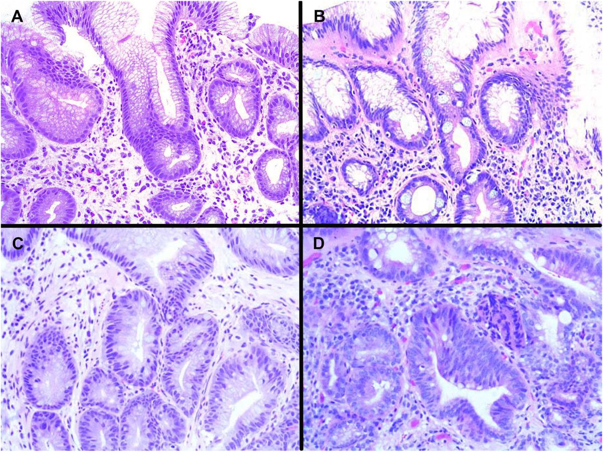 Clinical, molecular, and outcome study examines significance of crypt atypia in #BarrettsEsophagus. Check out the full article here ➡️ow.ly/9Qap50RaCEA