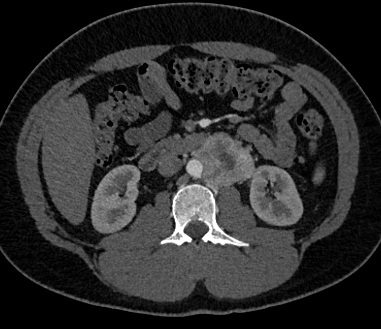 Paraganglioma Right Paraaortic Zone
