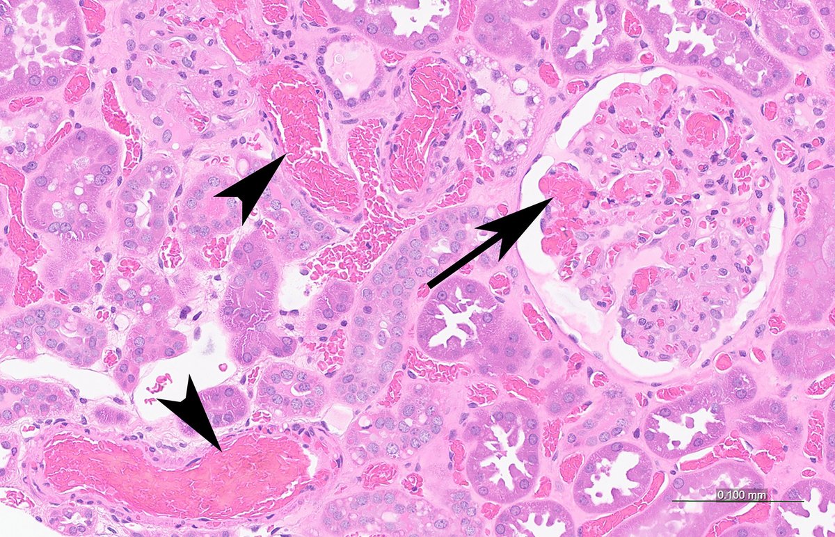 Sickle cell disease in the #kidneytransplant

doi.org/10.1016/j.kint…

#KINephrologyImage #sicklecelldisease
@MayoClinicPath @MayoClinicNeph @ldcornell @GWSMHS @MayoClinic