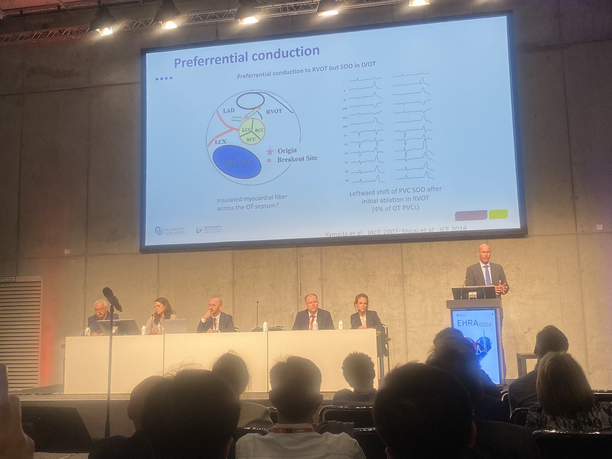 Educative talk by @EPDeneke about limitations of SoO determination algorithms for idiopathic PVCs! 💥Hourly PVC variability<50/h on Holter may be more accurate to discriminate RV from LV SoO as it does not depend on anatomy #EHRA2024 #EHRA_ESC #EPeeps #Arrhythmias