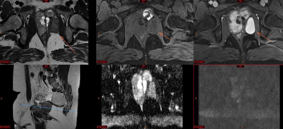 Fernando Ide Yamauchi (@nandoide) on Twitter photo 42 yo, LUTS, no PSA available (and unfortunately no answer yet...)
Any thoughts?
<a href="/SAR_ProstateDFP/">SAR Prostate DFP</a> <a href="/Purysko/">Andrei Purysko</a> <a href="/hiltonmlf/">Hilton Leão Filho</a> <a href="/lkayat/">Leonardo Kayat Bit..</a> <a href="/danatsouza/">Daniel Souza</a> <a href="/CasesCookyJar/">Cases From the Cooky Jar</a> <a href="/radiolobt/">Baris Turkbey MD</a> 42 yo, LUTS, no PSA available (and unfortunately no answer yet...)
Any thoughts?
<a href="/SAR_ProstateDFP/">SAR Prostate DFP</a> <a href="/Purysko/">Andrei Purysko</a> <a href="/hiltonmlf/">Hilton Leão Filho</a> <a href="/lkayat/">Leonardo Kayat Bit..</a> <a href="/danatsouza/">Daniel Souza</a> <a href="/CasesCookyJar/">Cases From the Cooky Jar</a> <a href="/radiolobt/">Baris Turkbey MD</a>