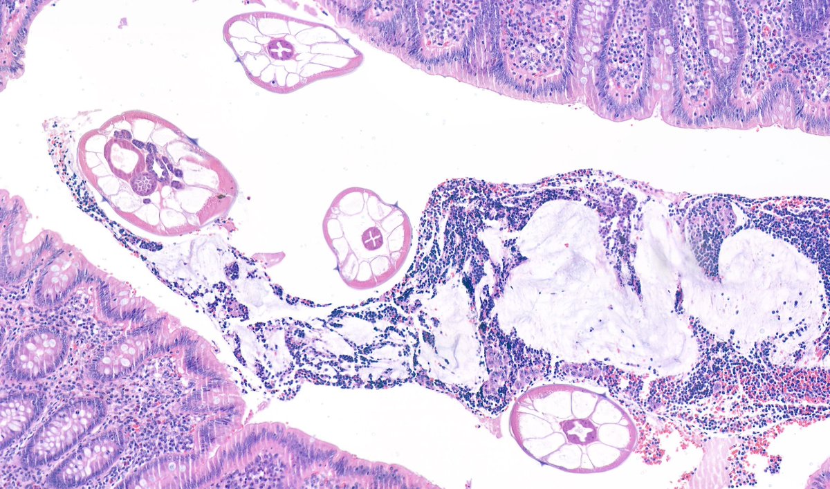 Appendix with intraluminal Enterobius vermicularis. #GIpath