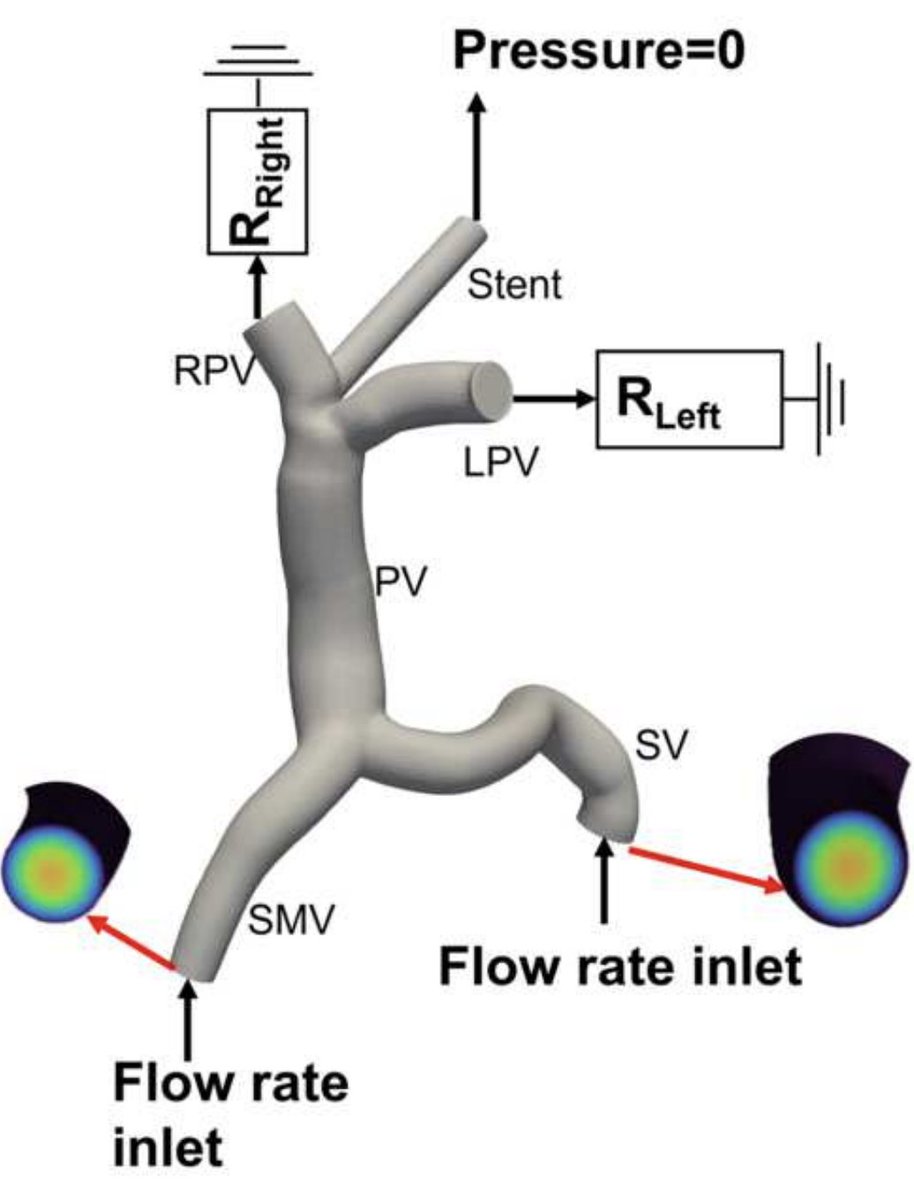 😃New article published in J Biomech!

'A new computational fluid dynamics based noninvasive assessment of portacaval pressure gradient, by Xiong et al.

sciencedirect.com/science/articl…

#journalofbiomechanics