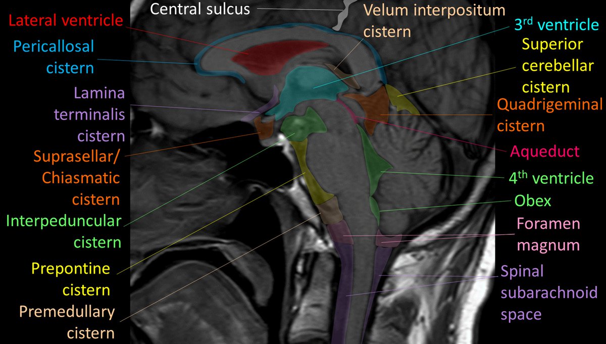 Sink or swim! Brain is swimming in CSF! CSF is key for protection, buoyancy, & hormone/waste transport Most know basic ventricular anatomy well, but not subarachnoid anatomy. How many cisterns do YOU know? Here’s a quick guide to the key midline cisterns & what to know for…