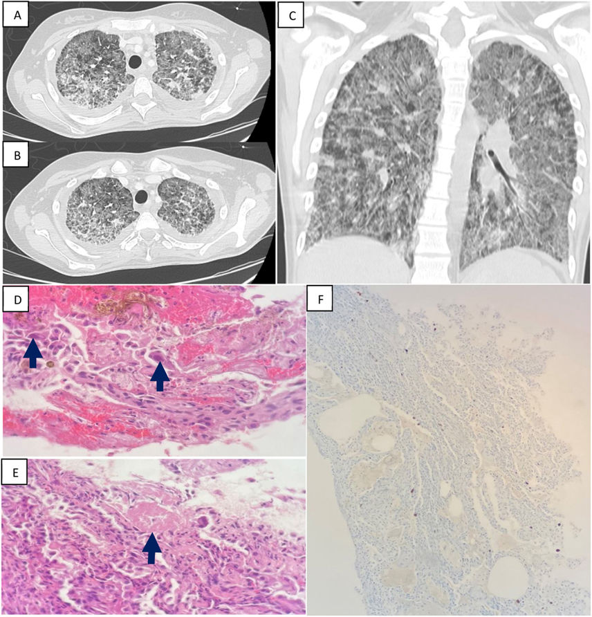 🫁 Hoy te presentamos una asociación poco común: 'Proteinosis alveolar pulmonar e infección por CMV' ➡️ Descúbrelo en una de nuestras últimas imágenes clínicas. 🔗 n9.cl/ra2ou3 #ArchivosdeBronconeumología