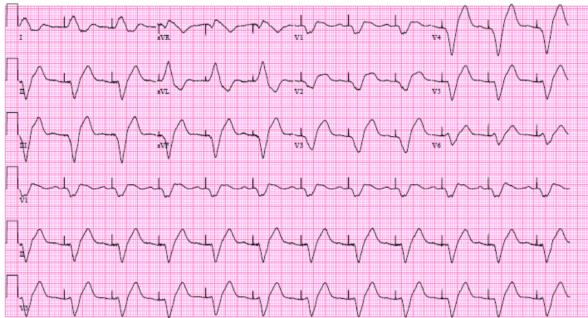 This is what happens when you eat too much Flecainide. This person has a pacemaker.