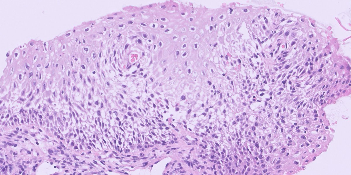 Cervical biopsy with the following histology 👇👇
Concurrent HPV-testing was negative.
What is your diagnosis?
#pathology #pathtwitter #gynpath